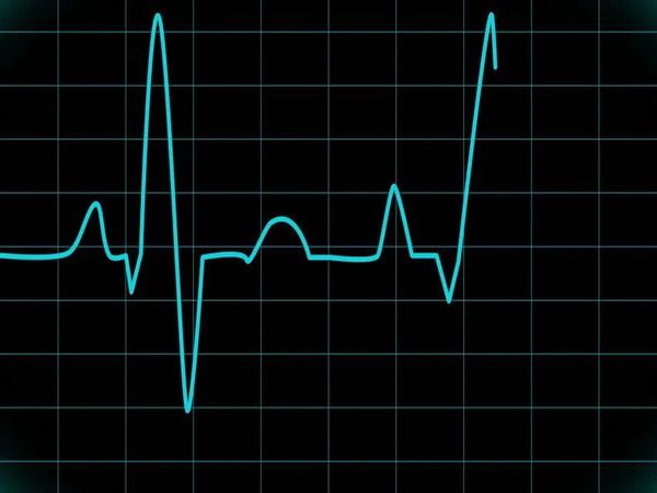 Arrhythmia Detection